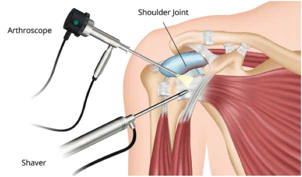 A Few Facts about Shoulder Arthroscopy