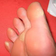 How to Prevent calluses from occurring?