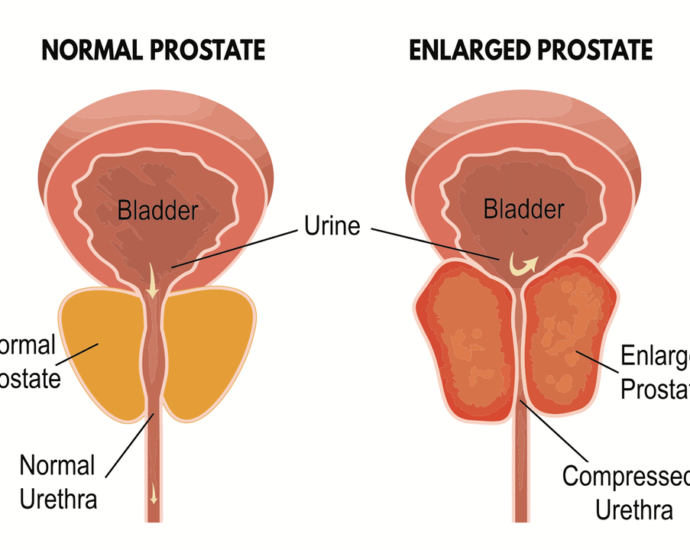 Symptoms of Enlarged Prostate