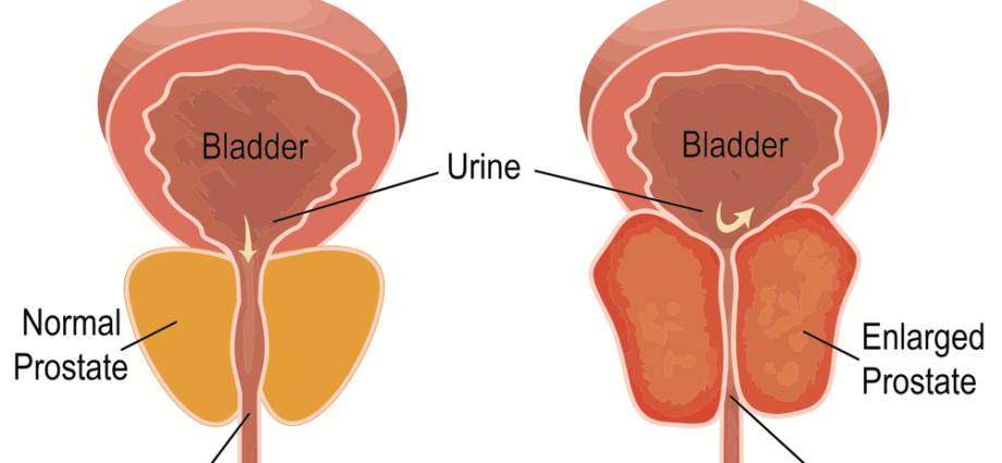 Symptoms of Enlarged Prostate