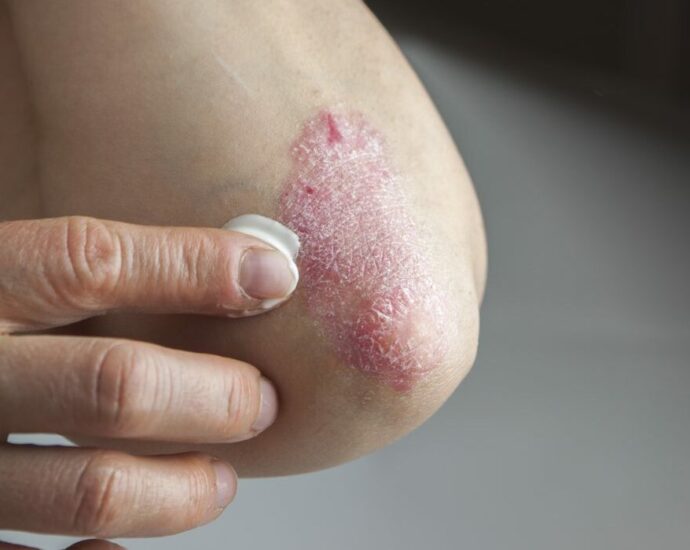 psoriasis home treatment