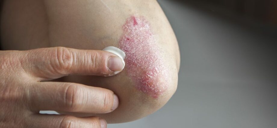 psoriasis home treatment