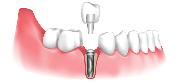 Are dental implants painful or not?