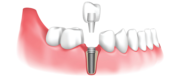 Are dental implants painful or not?