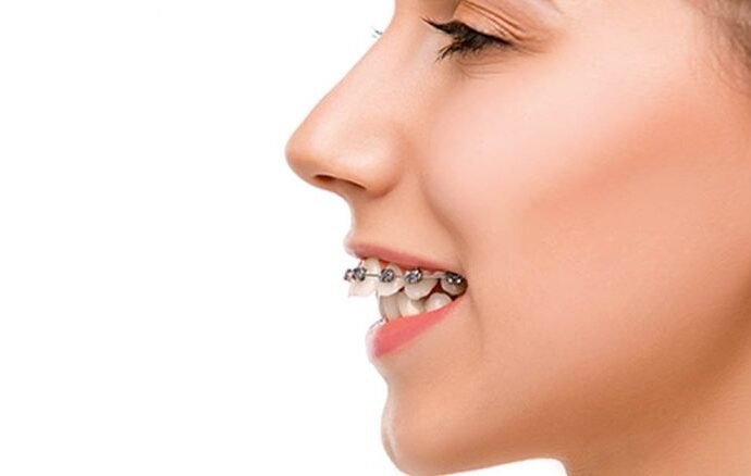 overbite braces