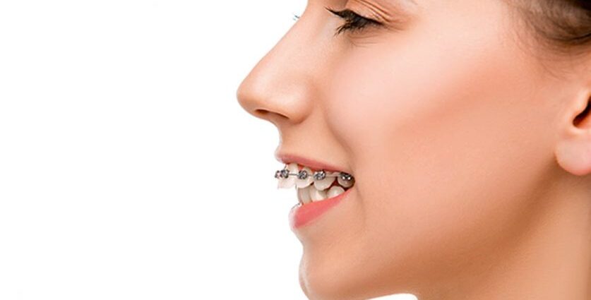 overbite braces