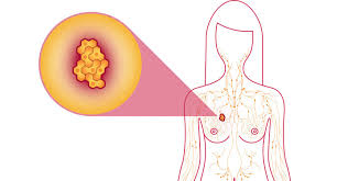 breast cancer treatment