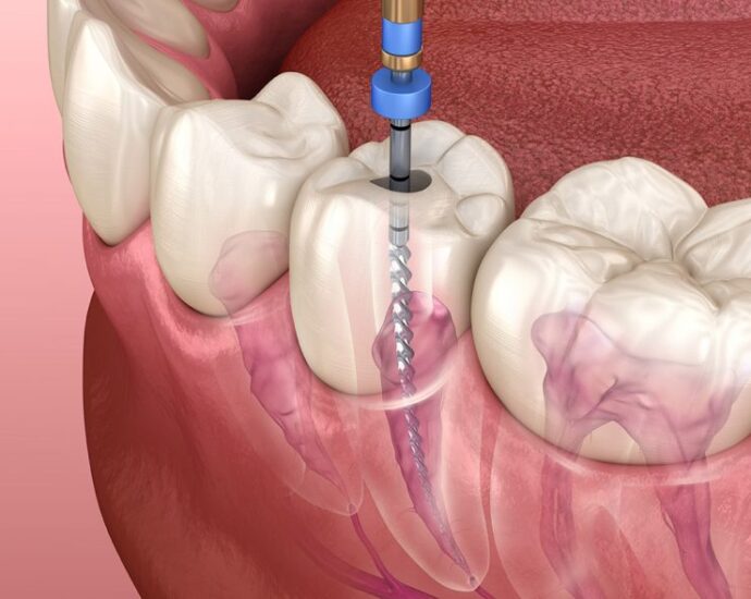 emergency root canal