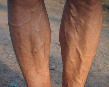 Sclerotherapy for varicose vein