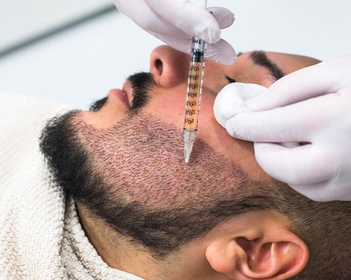 facial hair transplant