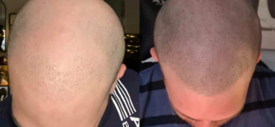 scalp micropigmentation