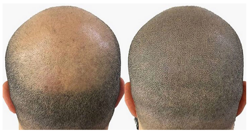 micropigmentation