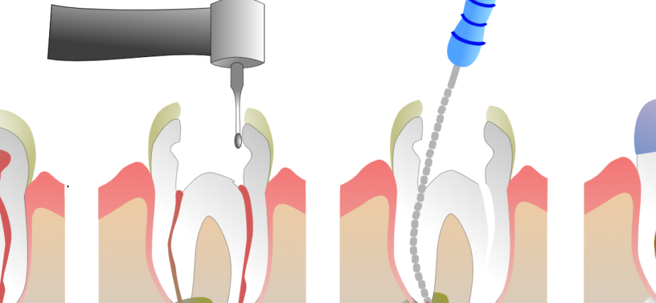 root-canal-illustration