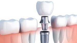 Dental Implants