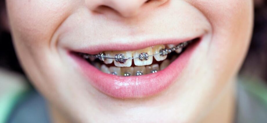 dental braces near me