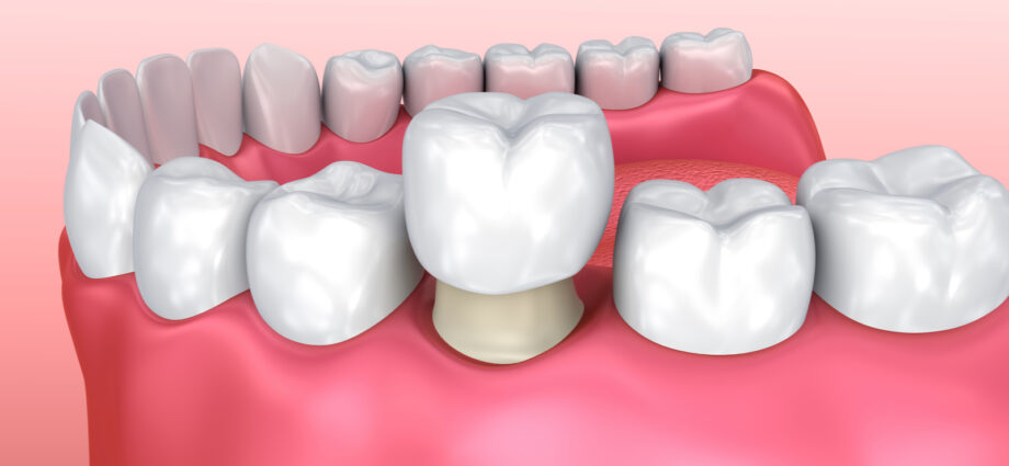 dental crowns near me