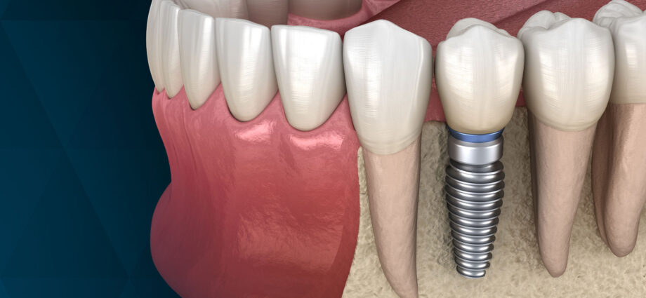 dental implants before and after