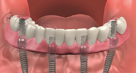 Dental Implant Solutions