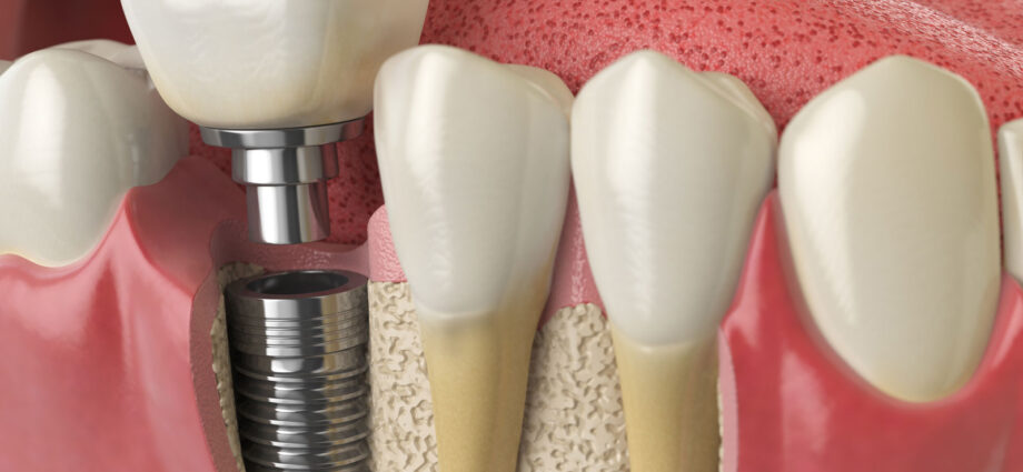 all on 4 dental implants