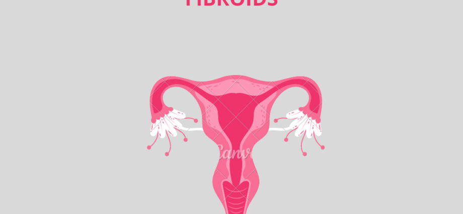 everything about fibroids