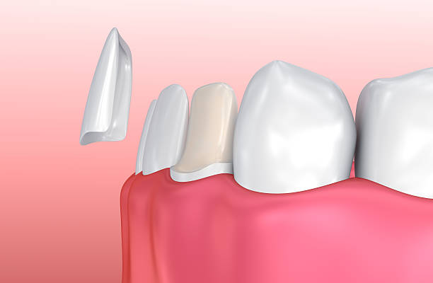 porcelain teeth veneers